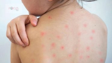 হাম প্রতিকার ও প্রতিরোধ করবেন যেভাবে